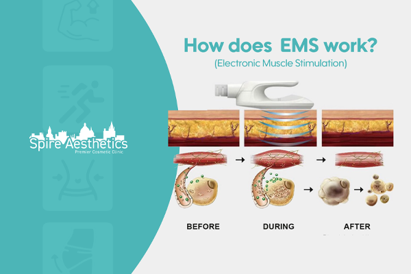 EMS treatment for post pregnancy weight loss treatment Wincanton