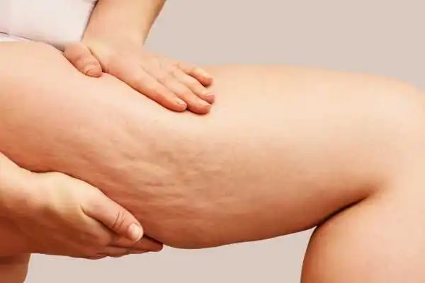 Image of woman showing leg with cellulite Wincanton