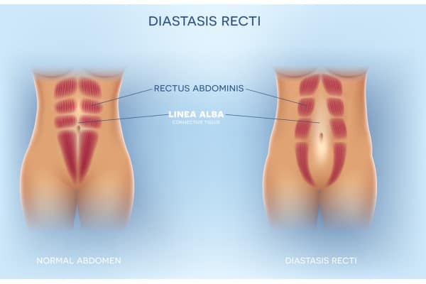 What Non-Surgical Options Are Available for Diastasis Recti Wincanton?