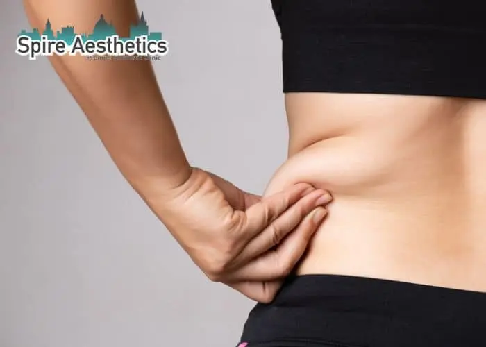 Image of woman pinching fat on their hips Wincanton. Fat Freezing treatment