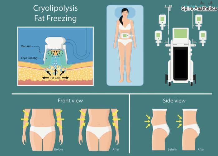 Image of diet and fat freezing combined for best results for Spire Aesthetics Wincanton