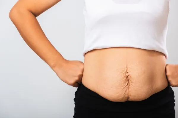 Image of a woman's stomach after weight loss with sagging skin following a gastric band Wincanton