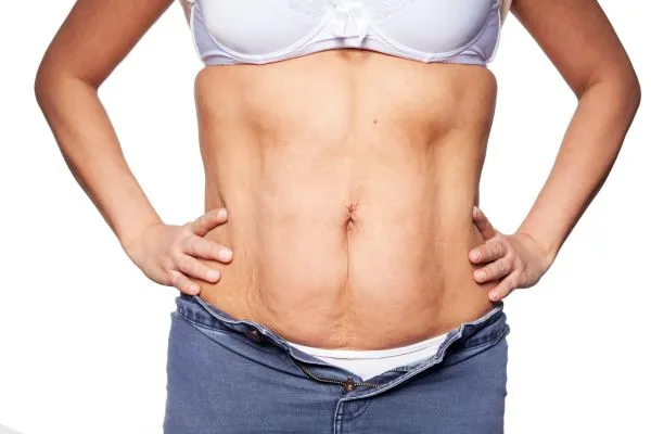 sagging skin on woman's stomach after weight loss injections Wincanton