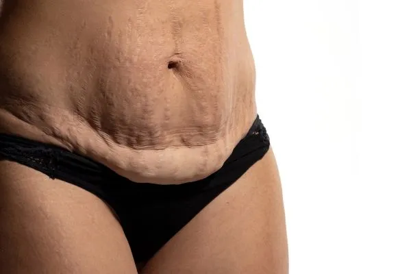 Image of womans stomach after weight loss injections Wincanton showing saggy skin