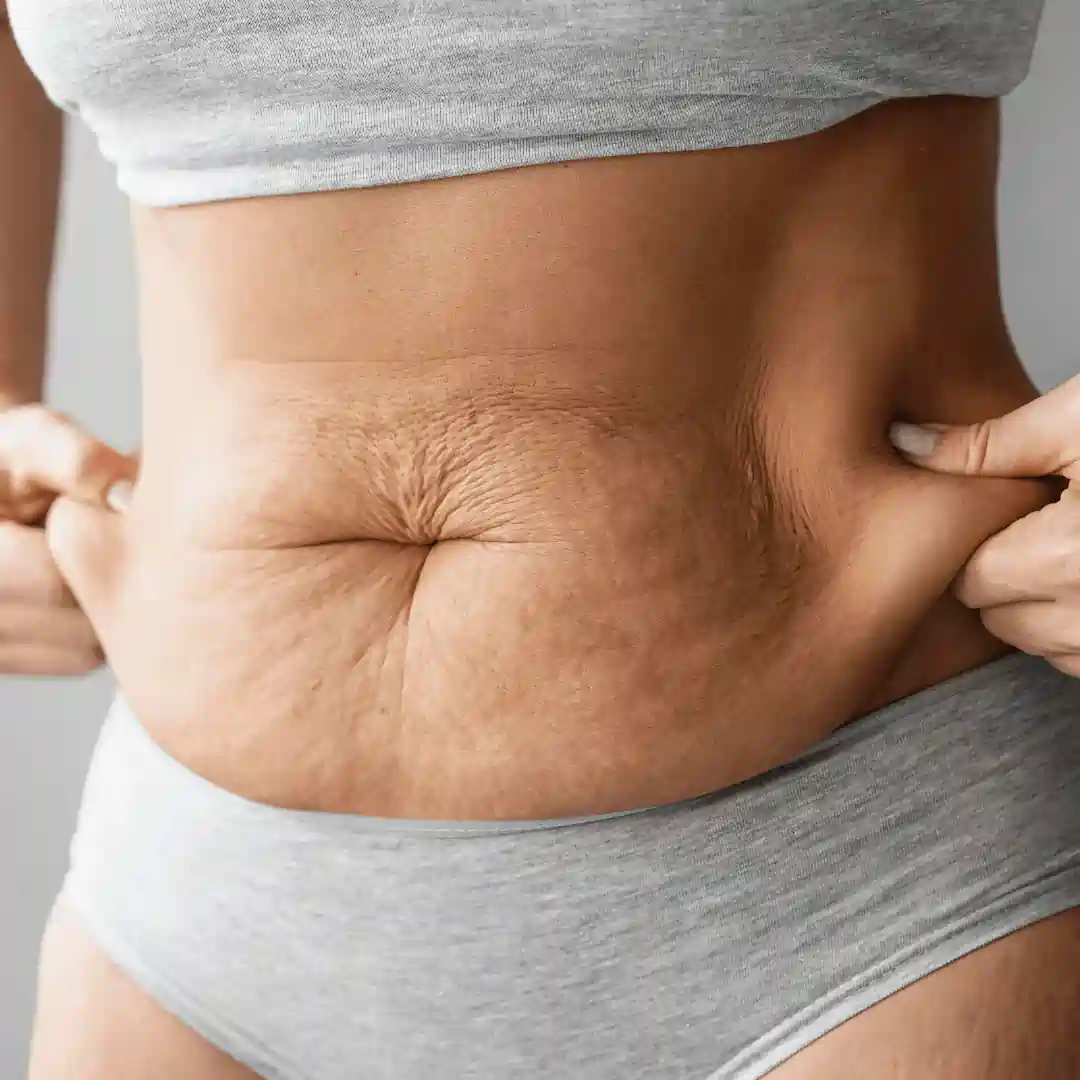 Is It Normal to Have Loose Skin After Pregnancy Wincanton?