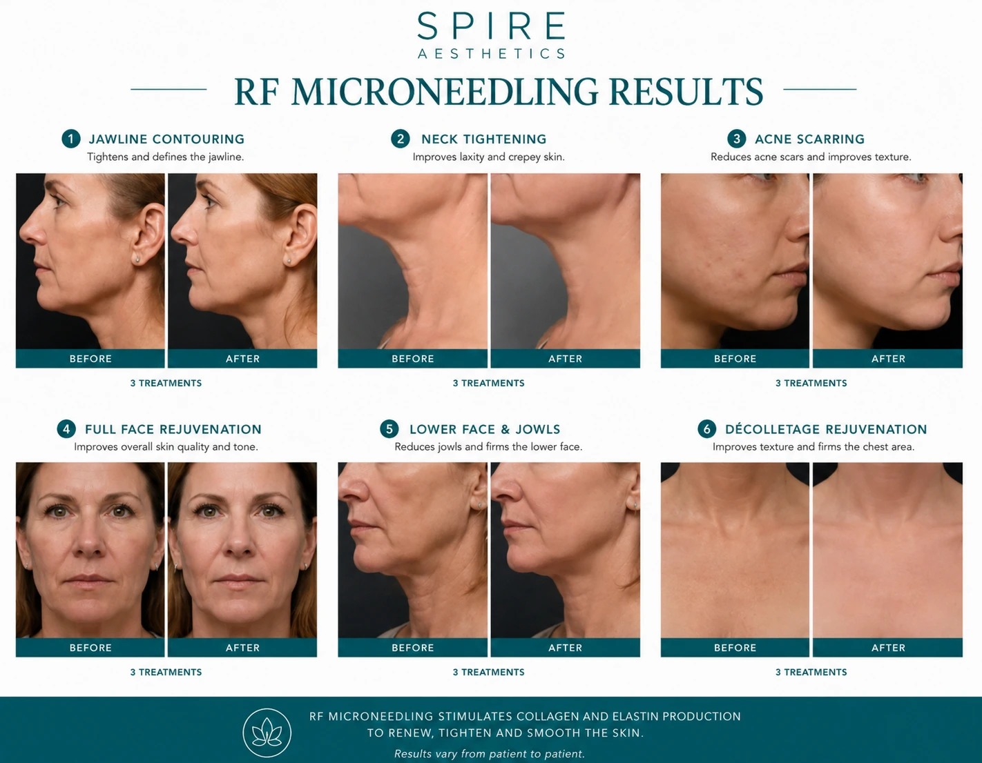 RF Microneedling Skin tightening Wincanton results