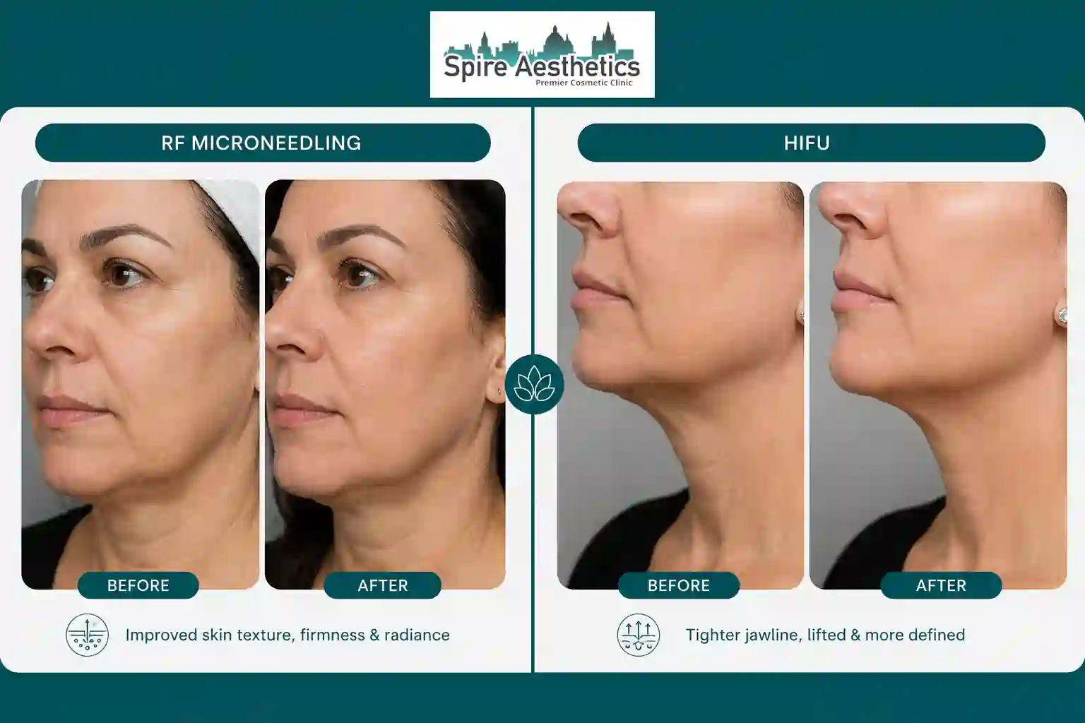 Can RF Microneedling and HIFU Be Combined Wincanton?