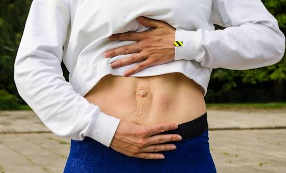 When Could Diastasis Recti Be the Missing Piece of the Puzzle Wincanton?